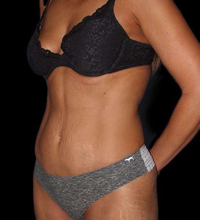 Tummy Tuck Before & After Patient #2269