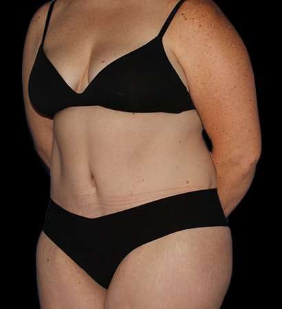 Tummy Tuck Before & After Patient #2280