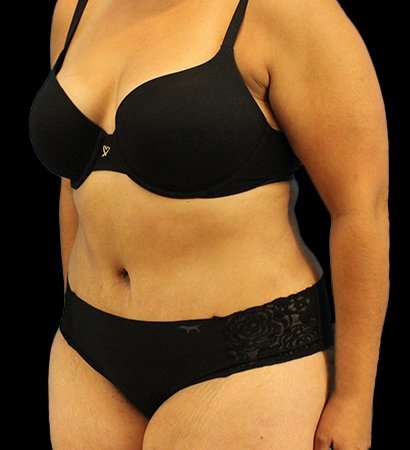 Tummy Tuck Before & After Patient #2291