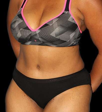 Tummy Tuck Before & After Patient #2302