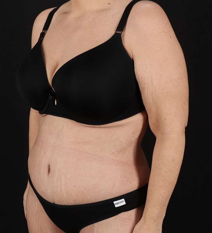 Tummy Tuck Before & After Patient #2326