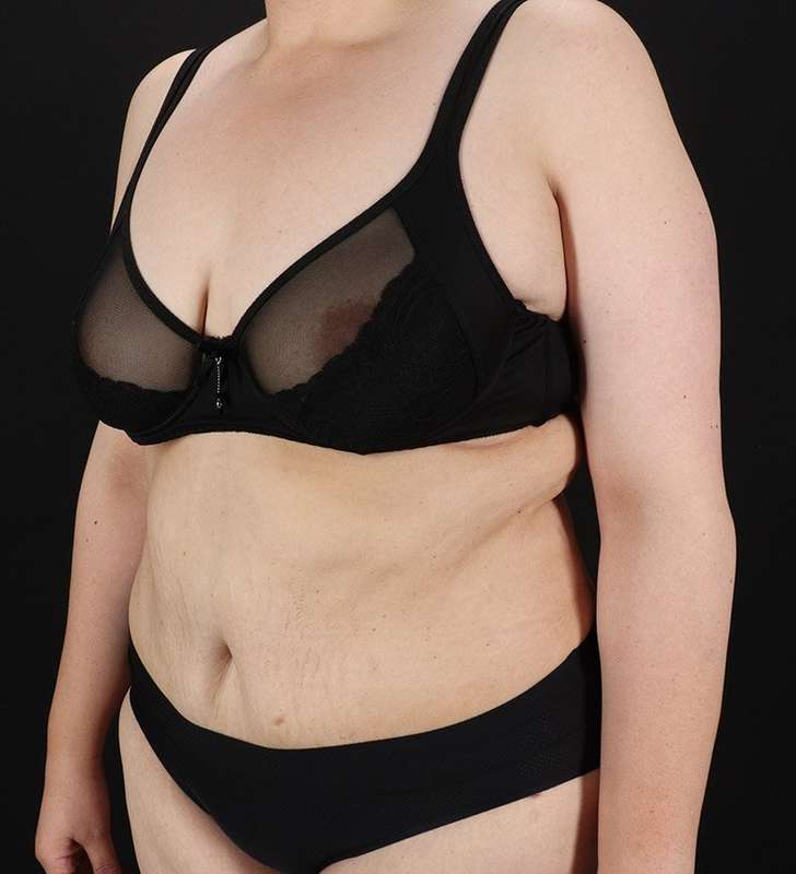 Tummy Tuck Before & After Patient #2339