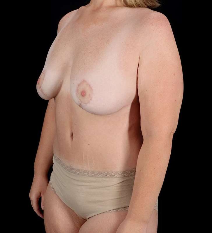 Tummy Tuck Before & After Patient #2413