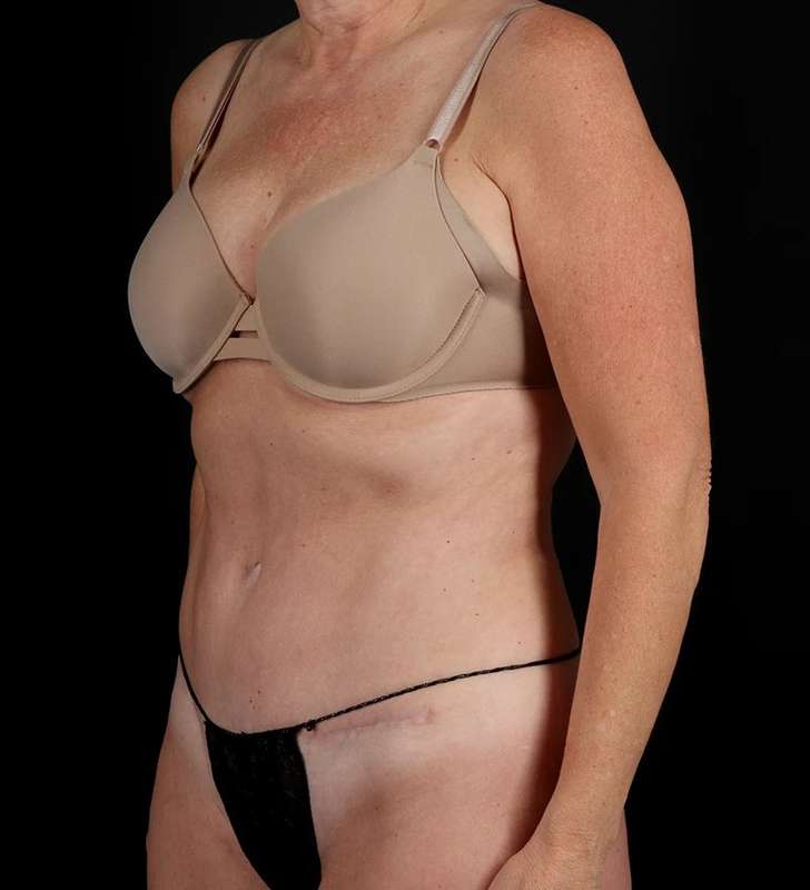 Tummy Tuck Before & After Patient #2435