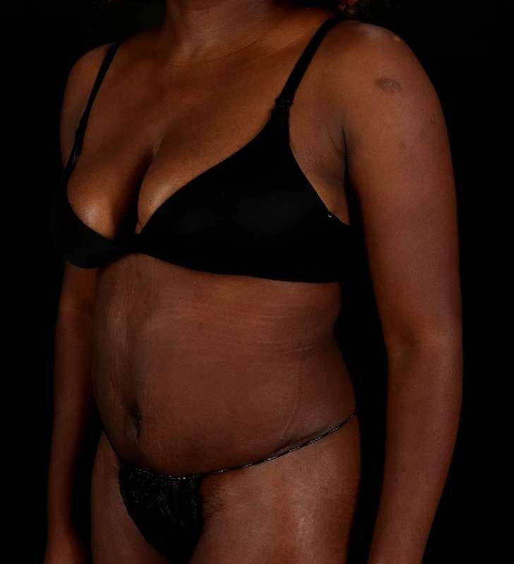 Tummy Tuck Before & After Patient #2448