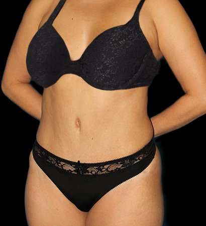 Tummy Tuck Before & After Patient #2485