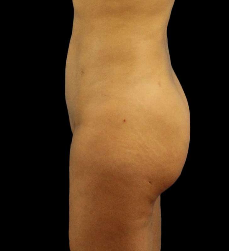 Brazilian Butt Lift Before & After Patient #2496