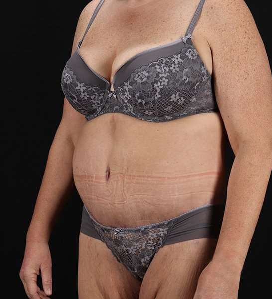 Circumferential Body Lift Before & After Patient #2509