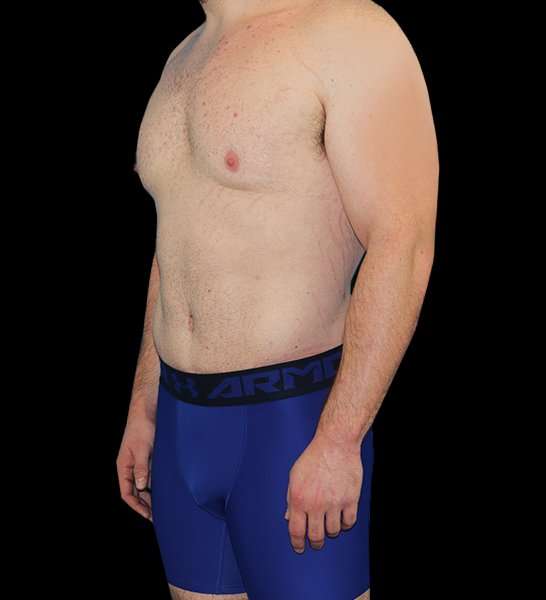 Circumferential Body Lift Before & After Patient #2522