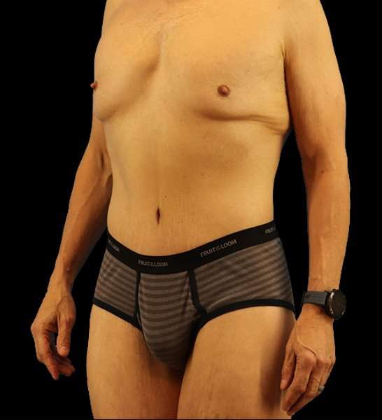 Circumferential Body Lift Before & After Patient #2535