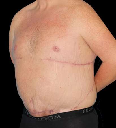 Massive Weight Loss Before & After Patient #5155