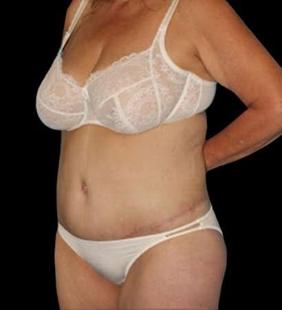 Circumferential Body Lift Before & After Patient #2572