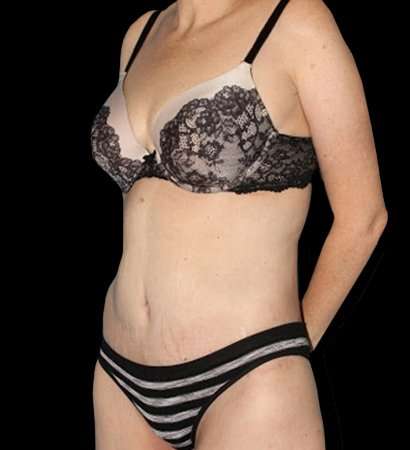 Circumferential Body Lift Before & After Patient #2598