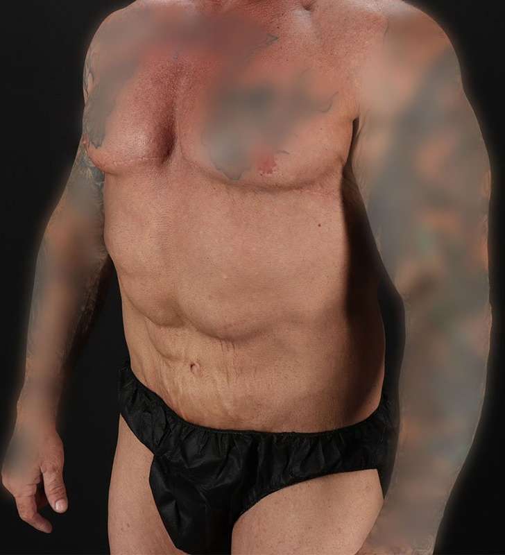 Circumferential Body Lift Before & After Patient #2611
