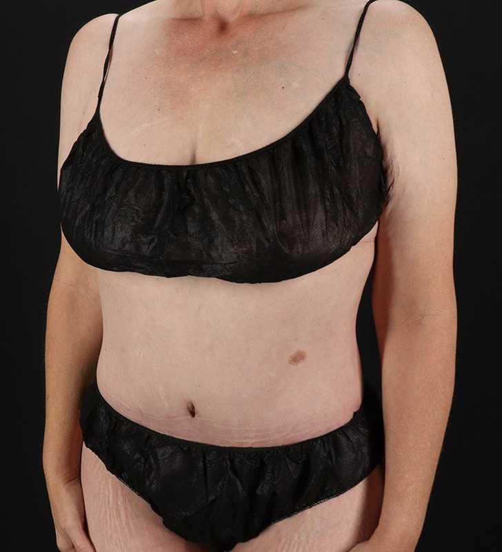Circumferential Body Lift Before & After Patient #2624