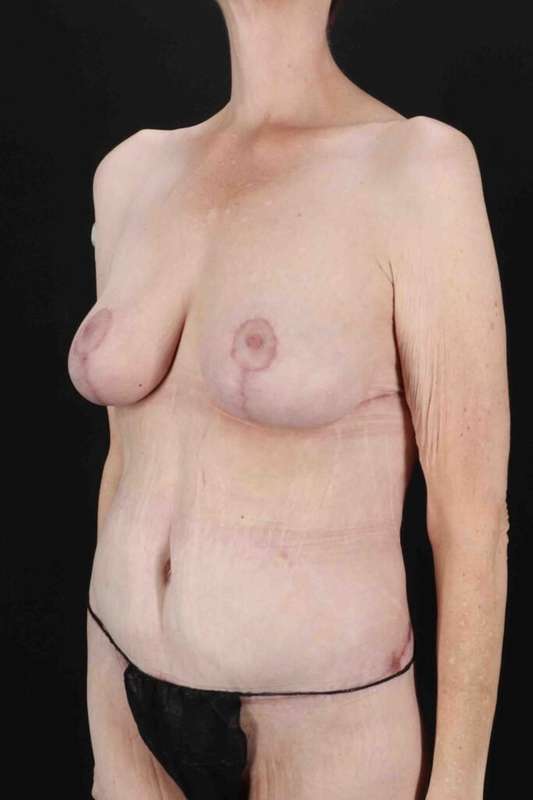 Circumferential Body Lift Before & After Patient #2663