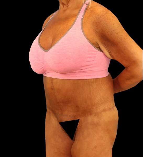 Fleur De Lis Circumferential Body Lift Before & After Patient #2674