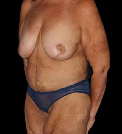 Fleur De Lis Circumferential Body Lift Before & After Patient #2685