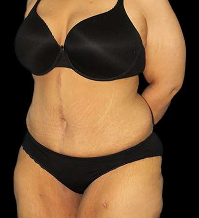 Fleur De Lis Tummy Tuck Before & After Patient #2703
