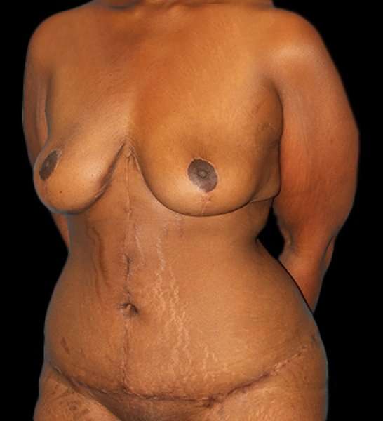 Fleur De Lis Tummy Tuck Before & After Patient #2714