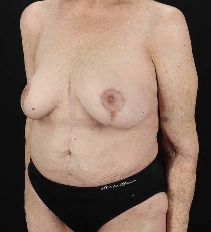 Fleur De Lis Tummy Tuck Before & After Patient #2727