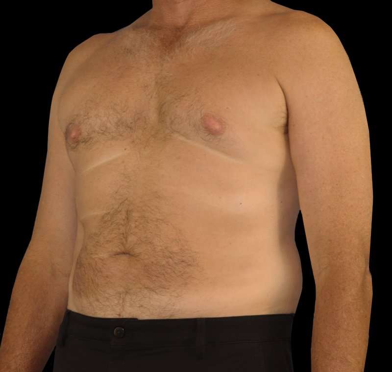 Liposuction Before & After Patient #2756