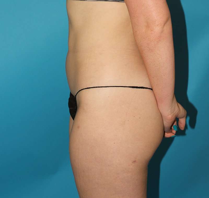 Liposuction Before & After Patient #2767