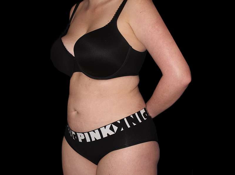 Liposuction Before & After Patient #2778