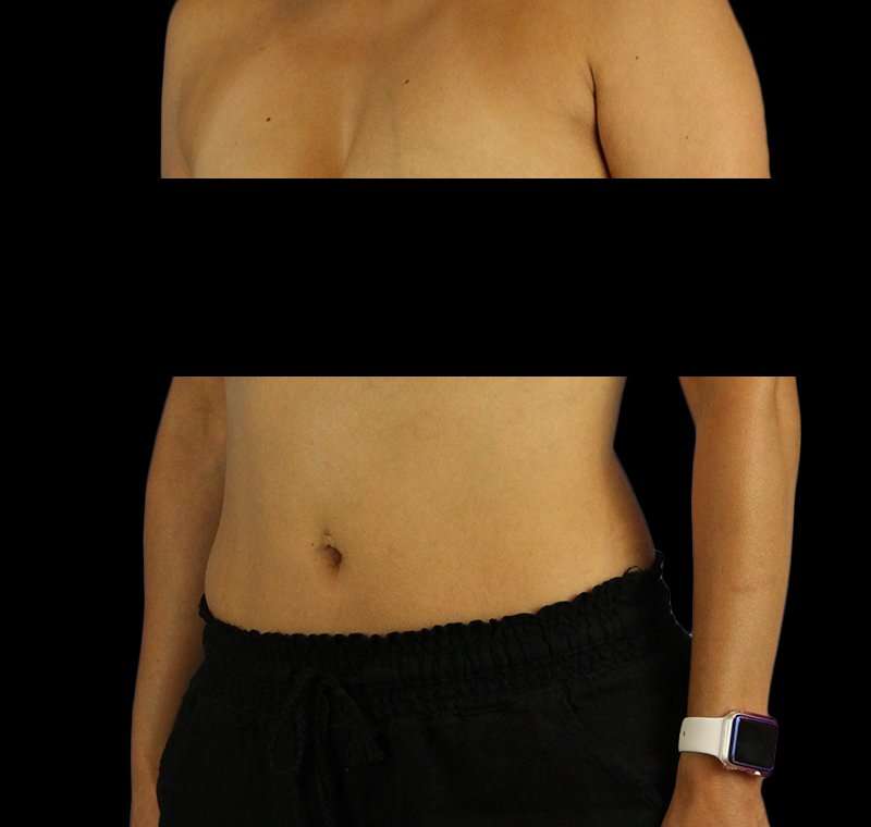Liposuction Before & After Patient #2811