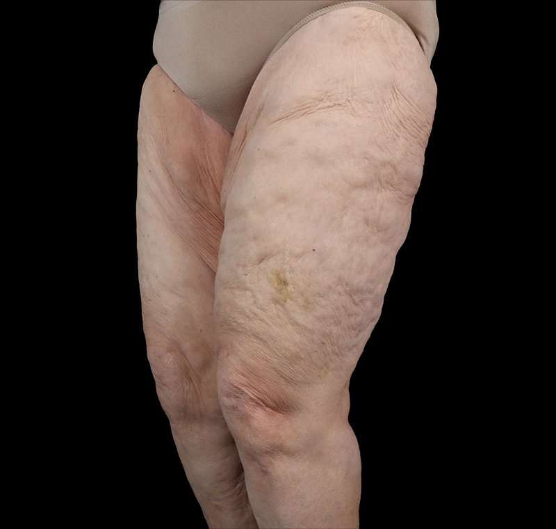 Liposuction Before & After Patient #2829