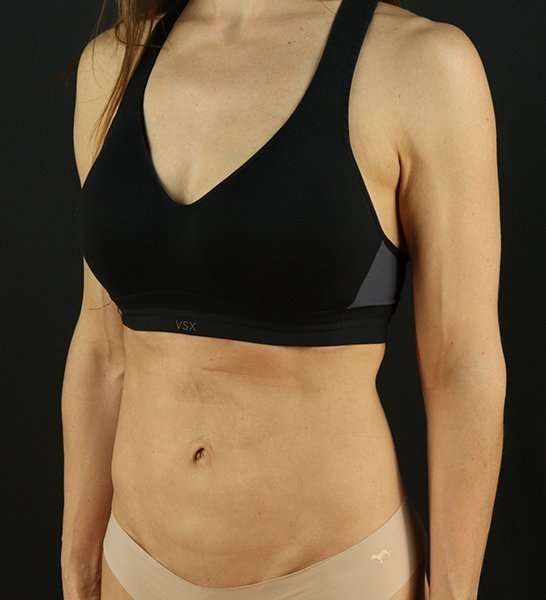 Mini Tummy Tuck Before & After Patient #2856