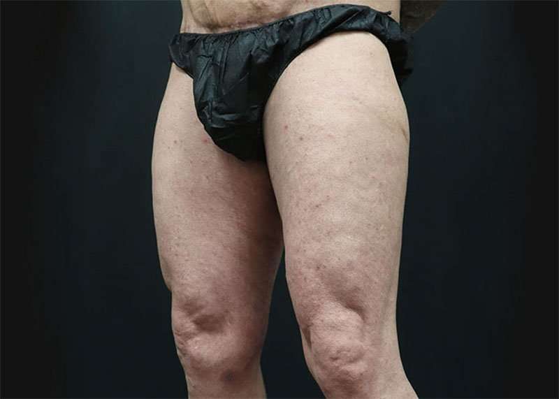 Thigh Lift Before & After Patient #2992