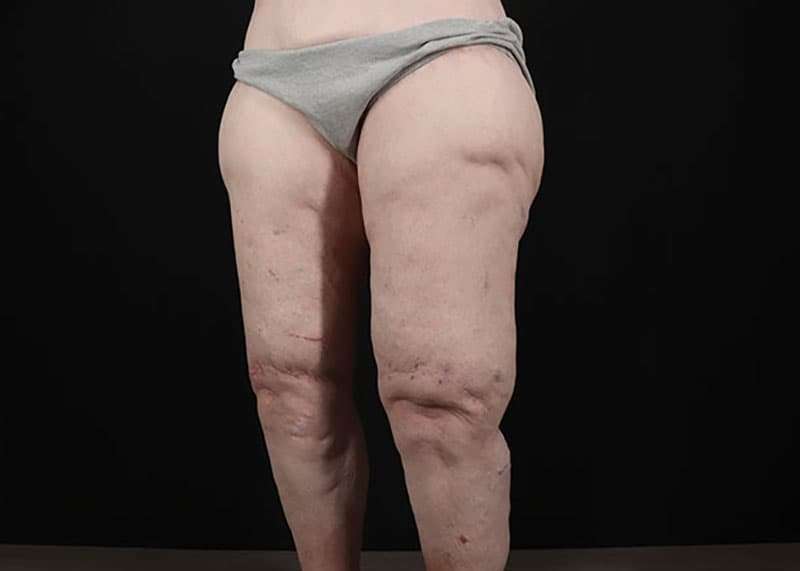 Thigh Lift Before & After Patient #3005