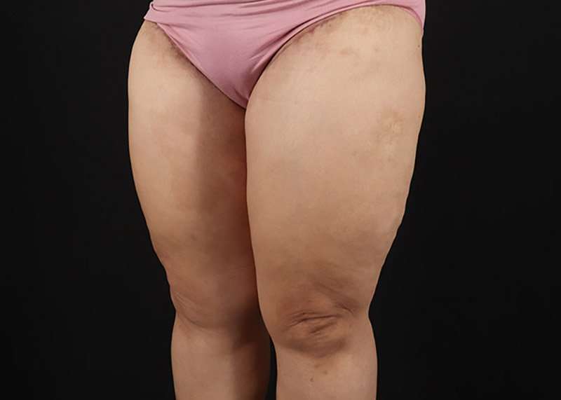 Thigh Lift Before & After Patient #3018