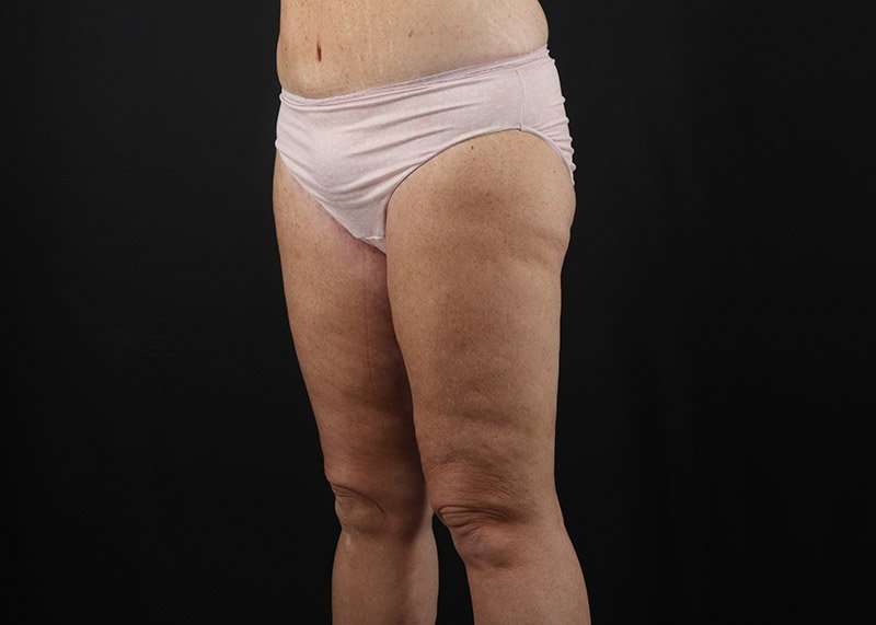 Thigh Lift Before & After Patient #3031