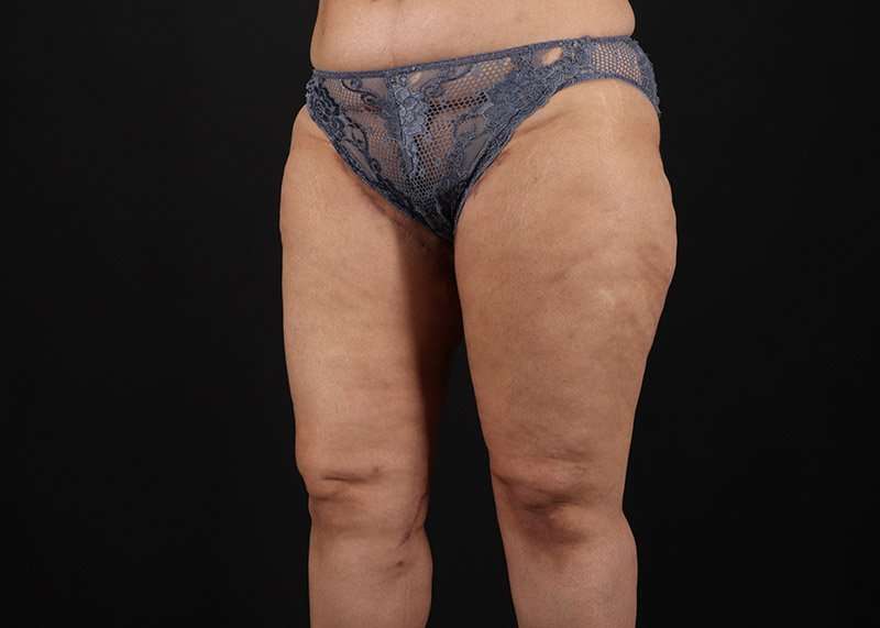 Thigh Lift Before & After Patient #3044