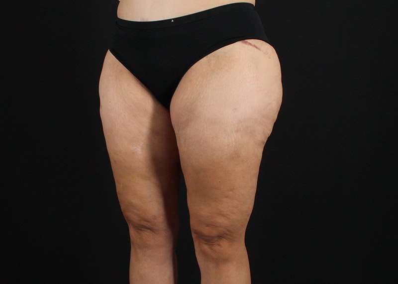 Thigh Lift Before & After Patient #3057