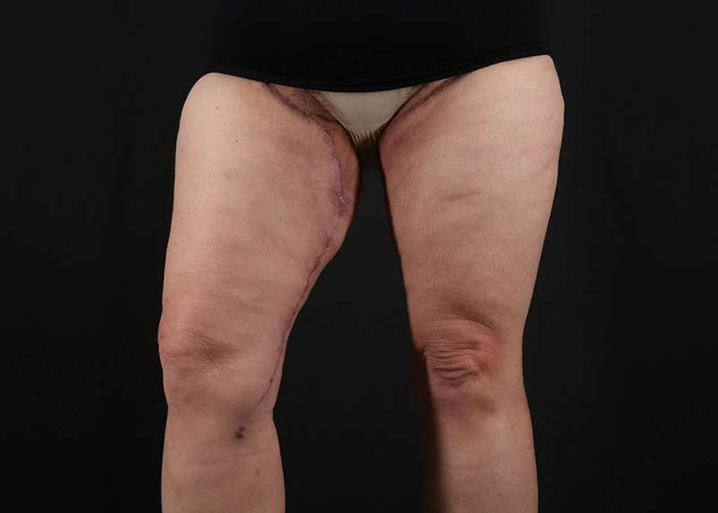 Thigh Lift Before & After Patient #3070