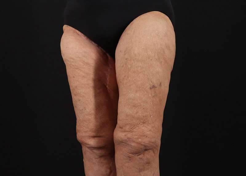 Thigh Lift Before & After Patient #3083