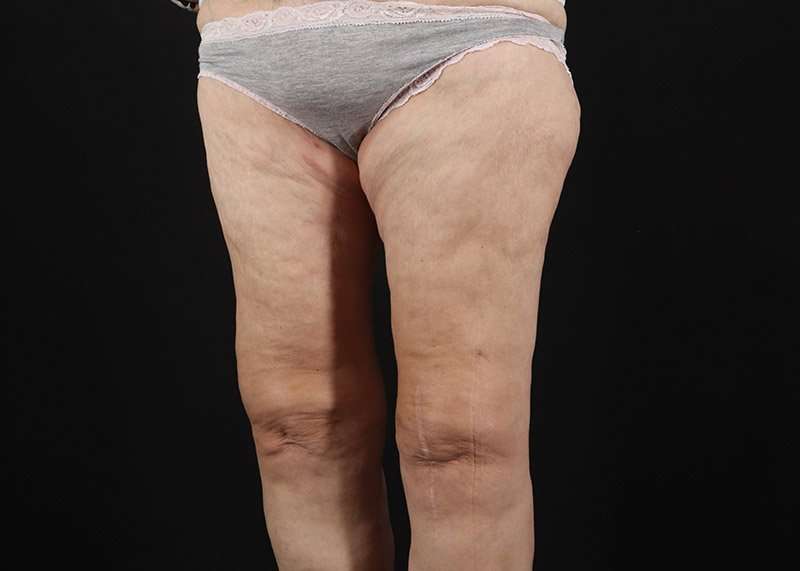 Thigh Lift Before & After Patient #3096