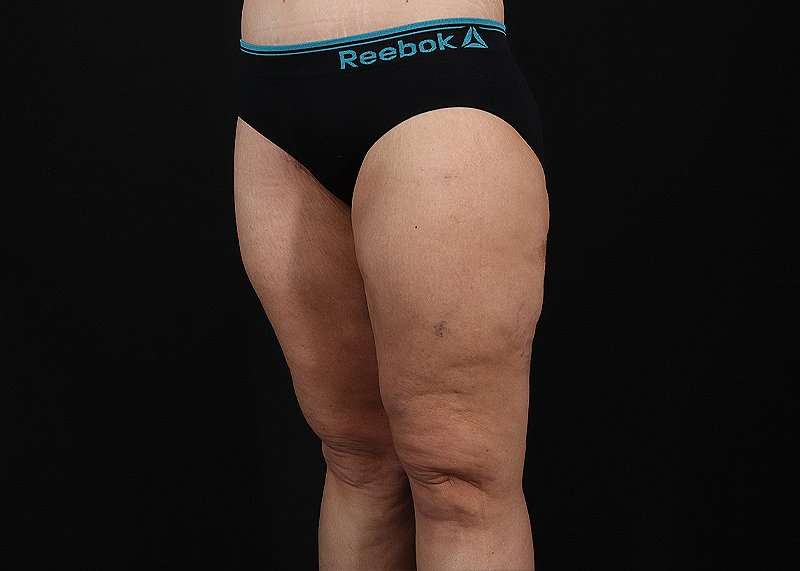 Thigh Lift Before & After Patient #3109