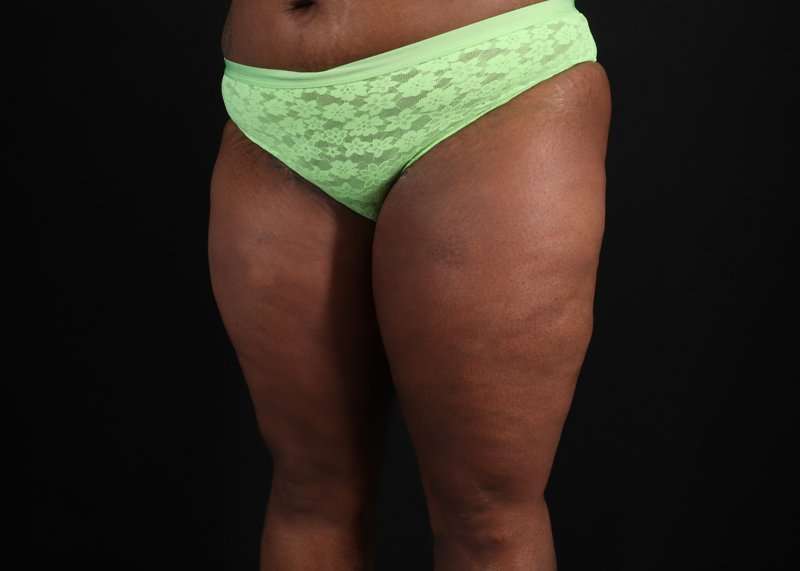 Thigh Lift Before & After Patient #3122