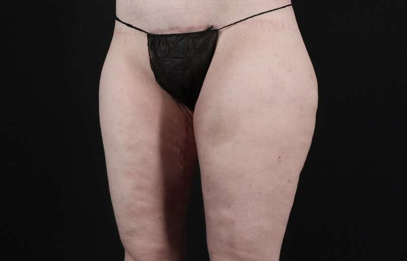 Thigh Lift Before & After Patient #3135