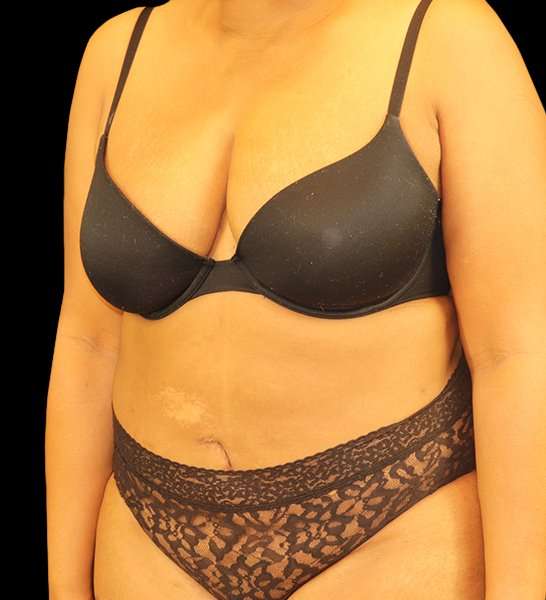 Tummy Tuck Revision Before & After Patient #3146