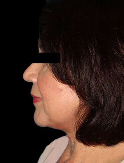 Face & Neck Lift Before & After Patient #3248