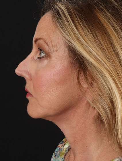 Face & Neck Lift Before & After Patient #3259