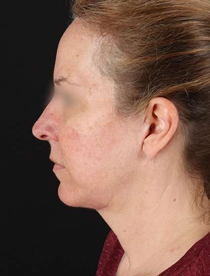 Face & Neck Lift Before & After Patient #3270