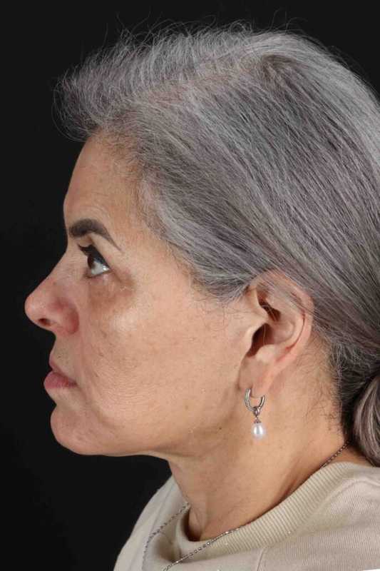 Face & Neck Lift Before & After Patient #3292
