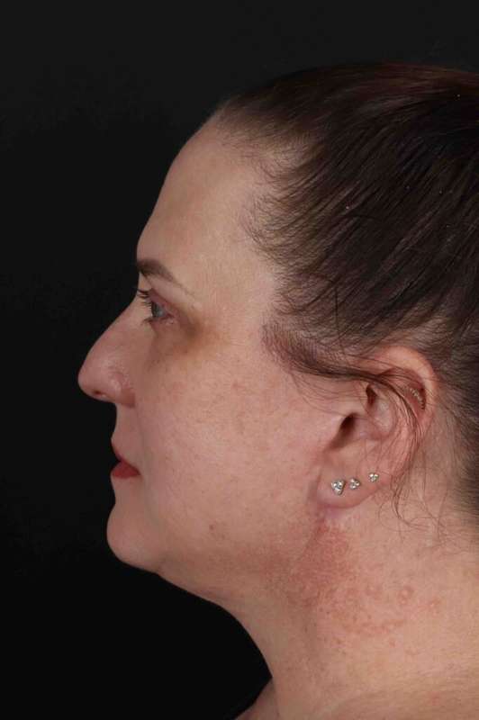 Face & Neck Lift Before & After Patient #3303