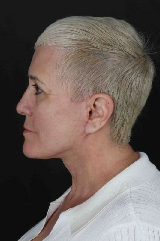 Face & Neck Lift Before & After Patient #3314
